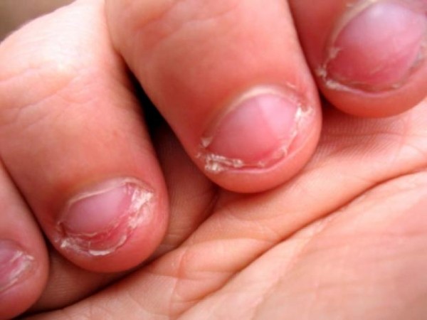 Четыре действенных способа избавиться от привычки грызть ногти Четыре действенных способа избавиться от привычки грызть ногти