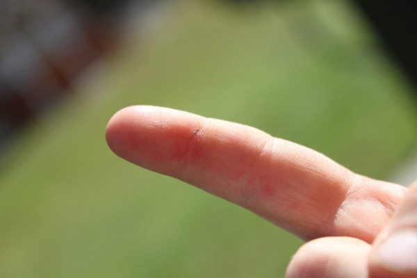 Несколько лайфхаков, как быстро вытащить занозу из пальца без иголки